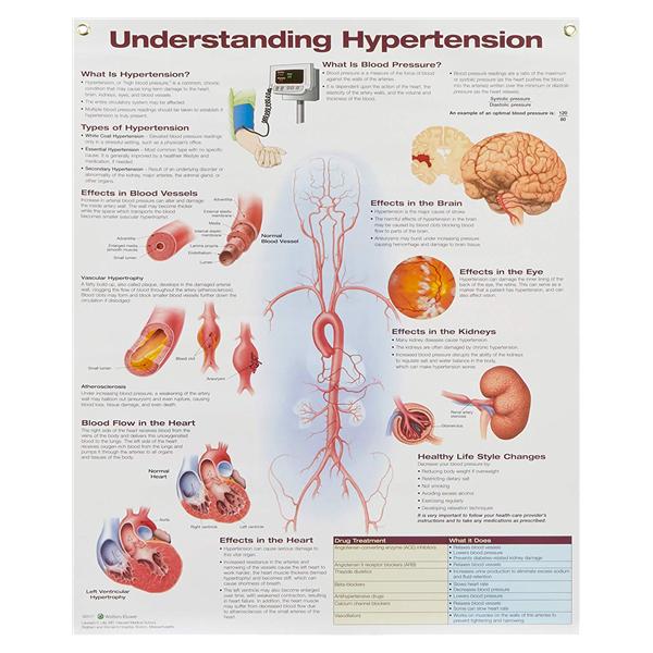 Chart Laminated Wall Understanding Hypertension 20x26\